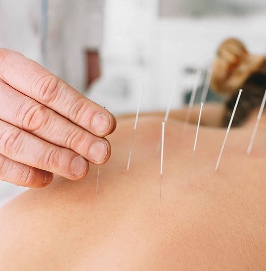 Acupuntura